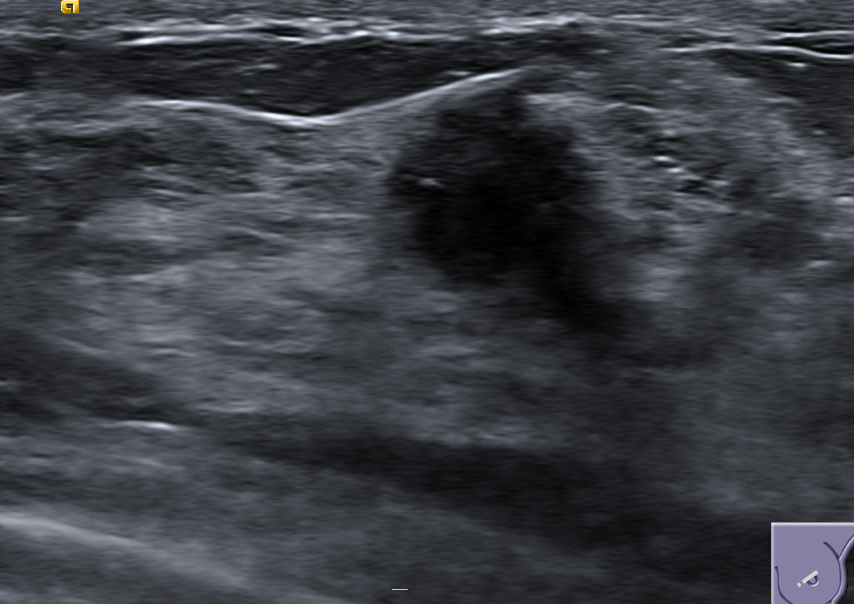 Breast ultrasound with a malignant lesion region outlined by the Clinara analyser